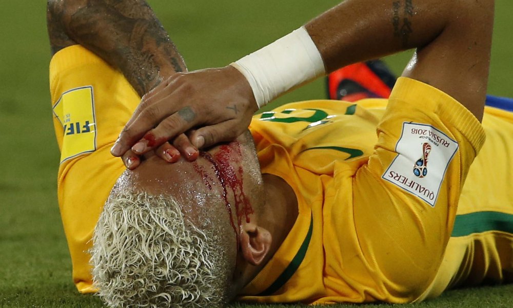 Neymar lies with his face bleeding on the pitch.