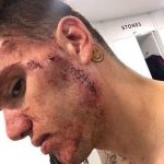 Ederson’s face after he was kicked by Sadio Mane on Saturday